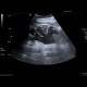 Hydronephrosis, end-stage: US - Ultrasound